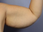 Arm Lift Before and after photo