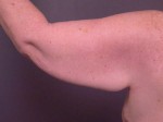 Arm Lift Before and after photo