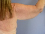 Arm Lift Before and after photo