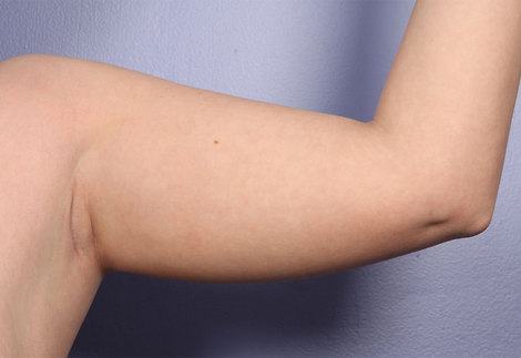 Arm Lift before and after photo