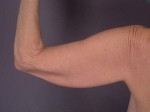 Arm Lift Before and after photo