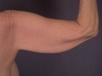 Arm Lift Before and after photo