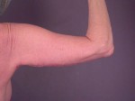 Arm Lift Before and after photo