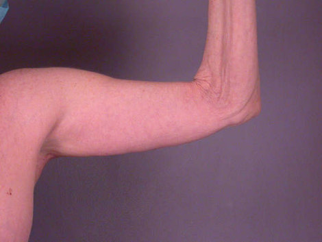 Arm Lift before and after photo