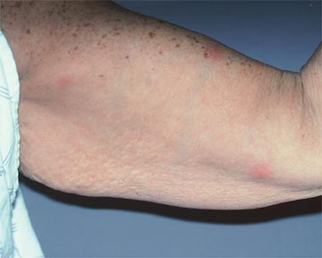 Arm Lift before and after photo