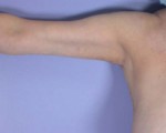 Arm Lift Before and after photo