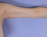 Arm Lift Before and after photo