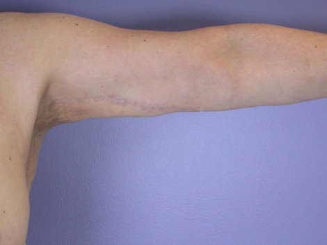 Arm Lift before and after photo