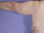 Arm Lift Before and after photo