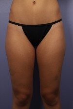 Liposuction Before and after photo