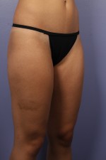 Liposuction Before and after photo