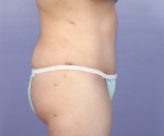 Liposuction Before and after photo