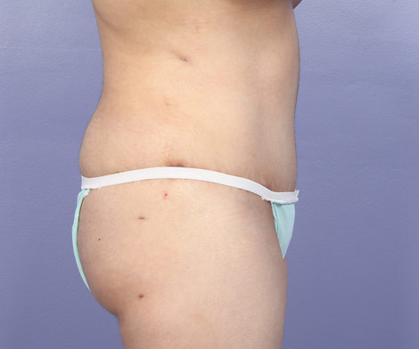 Liposuction before and after photo