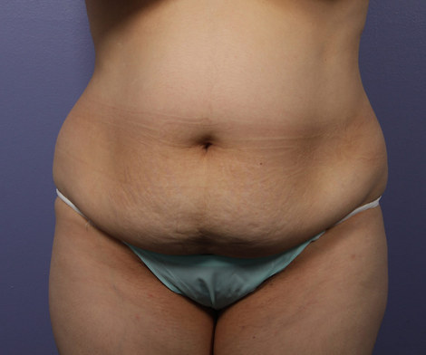 Liposuction before and after photo