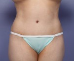 Liposuction Before and after photo