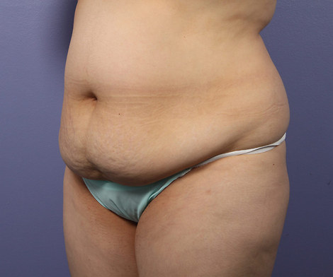 Liposuction before and after photo