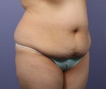 Liposuction Before and after photo