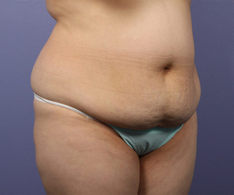 Liposuction before and after photo