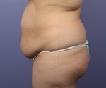 Liposuction Before and after photo