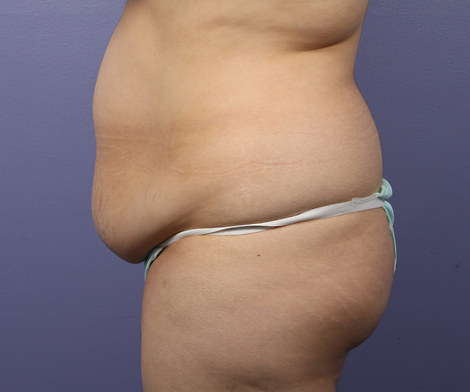 Liposuction before and after photo