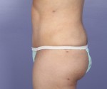 Liposuction Before and after photo