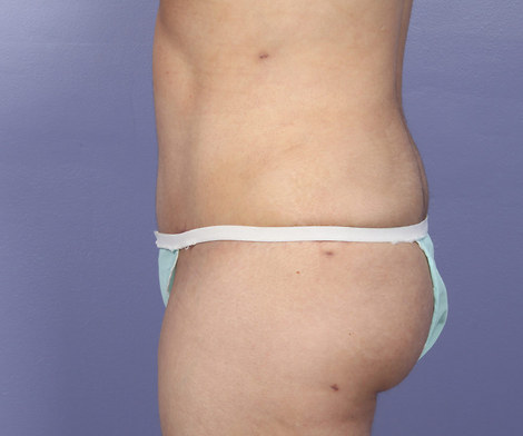 Liposuction before and after photo