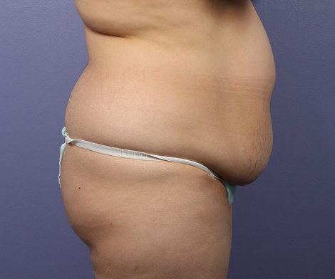 Liposuction before and after photo