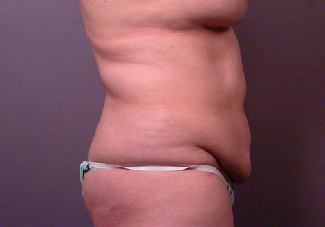 Liposuction before and after photo