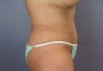 Liposuction Before and after photo