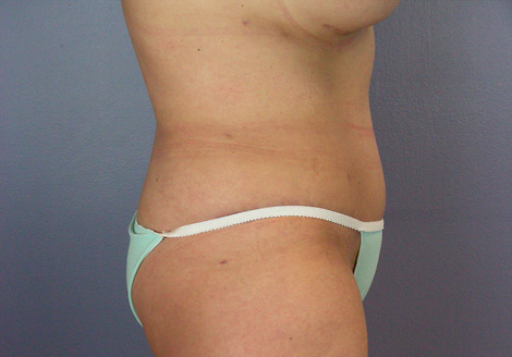 Liposuction before and after photo