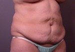 Liposuction Before and after photo