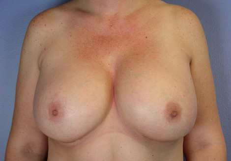 Liposuction before and after photo