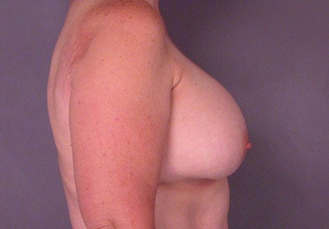 Liposuction before and after photo