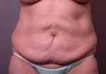 Liposuction Before and after photo