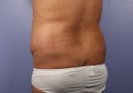 Liposuction Before and after photo