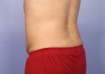 Liposuction Before and after photo