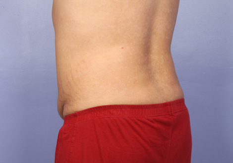 Liposuction before and after photo