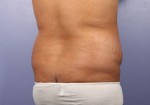 Liposuction Before and after photo