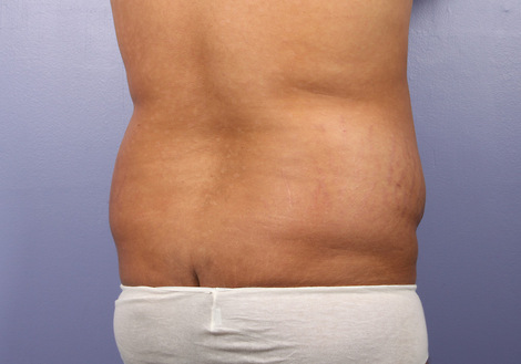 Liposuction before and after photo