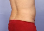 Liposuction Before and after photo