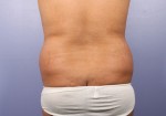 Liposuction Before and after photo