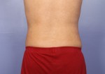 Liposuction Before and after photo