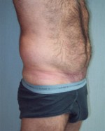 Liposuction Before and after photo