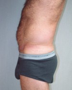 Liposuction Before and after photo