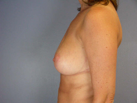 Liposuction before and after photo