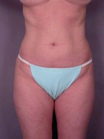 Liposuction Before and after photo