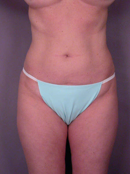 Liposuction before and after photo