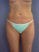 Liposuction Before and after photo