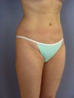 Liposuction Before and after photo