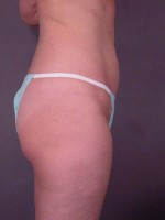 Liposuction Before and after photo